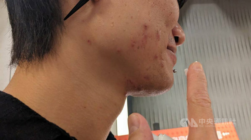 食藥署2日召開記者會,提醒民眾遵照醫囑使用青春痘外用與口服藥物。(中央社示意圖)